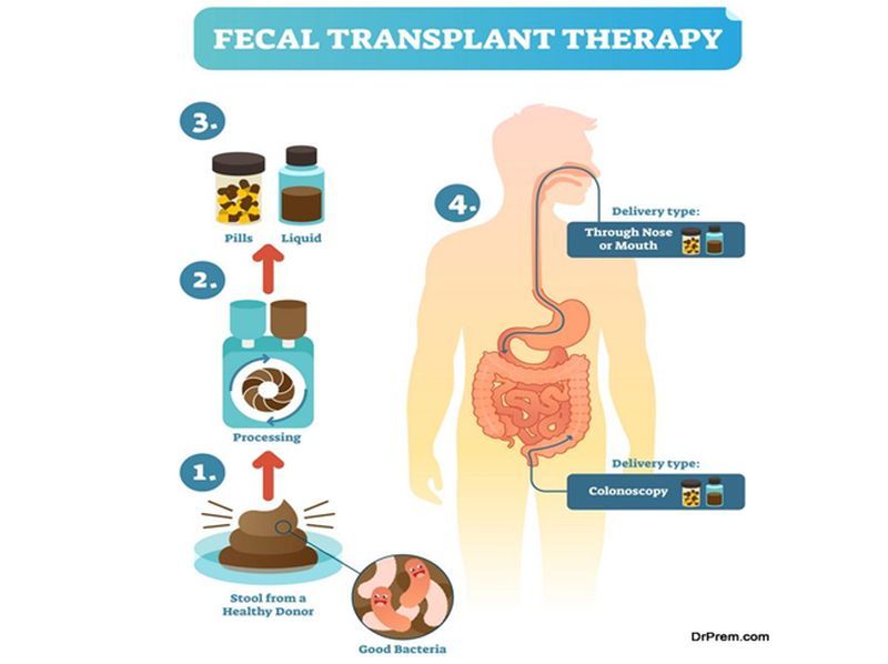 Fecal-Transplant