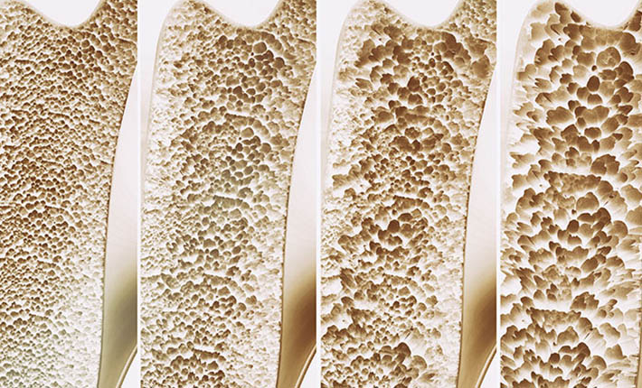 ارتباط استخوان های سالم و میکروبیوتای روده 