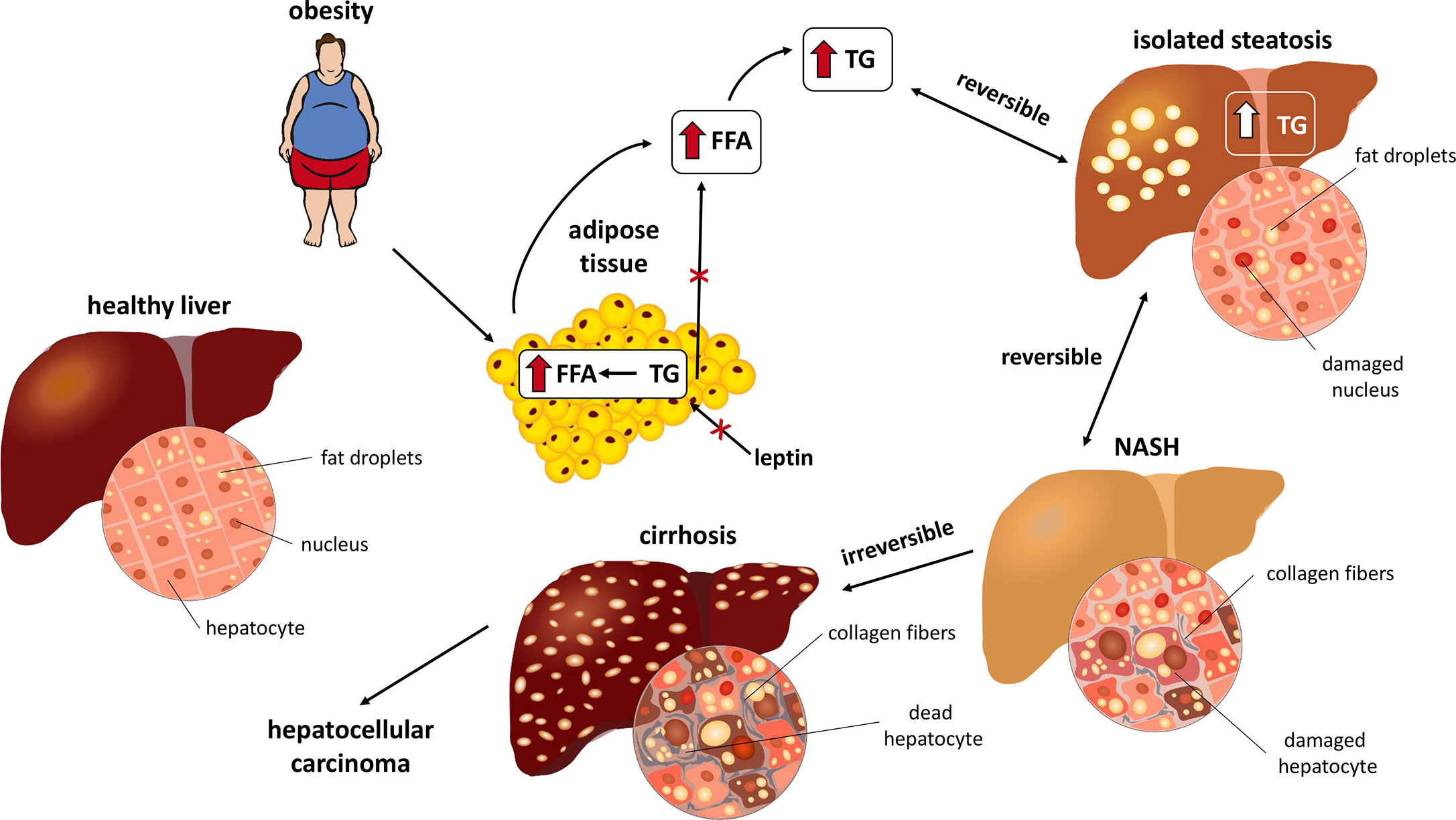 Current Pathogenic Paradigm and Therapeutic Aspect in Non-Alcoholic Fatty Liver Disease