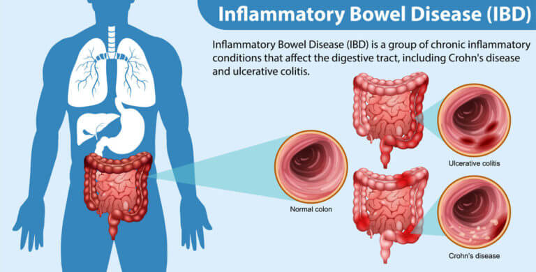 Inflammatory bowel disease | gutmicrobiotaforhealth